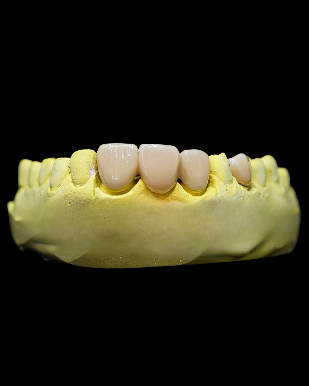 PFM (Porcelain Fused to Metal)