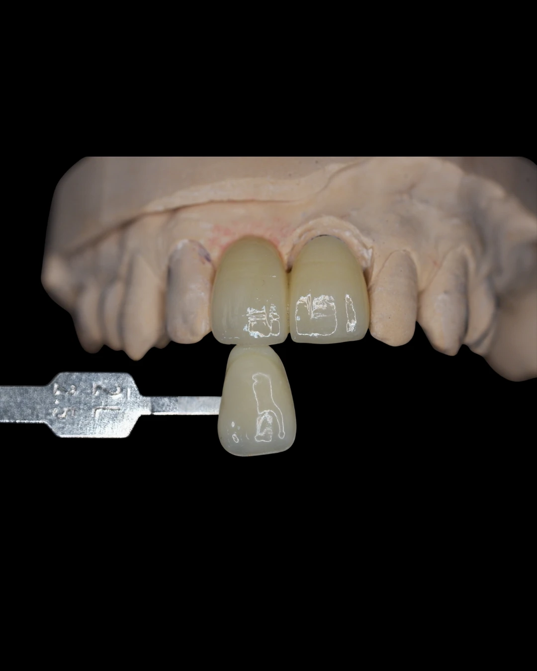 PFZ (Porcelain Fused to Zirconia)